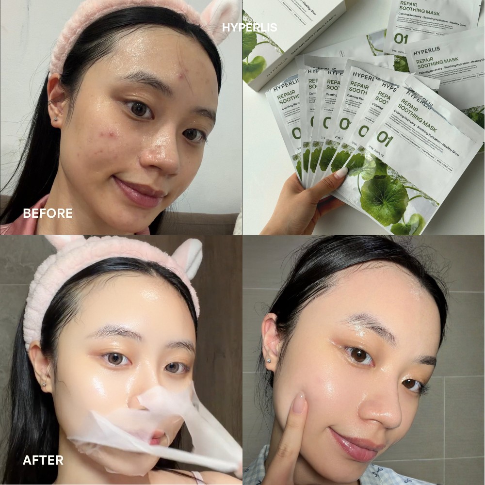 HYPERLIS Before/After 1