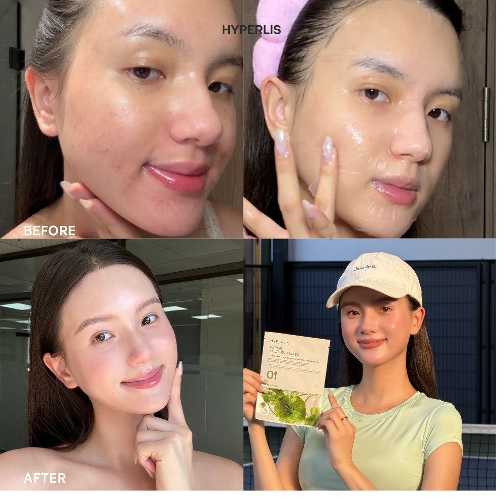 HYPERLIS Before/After 2